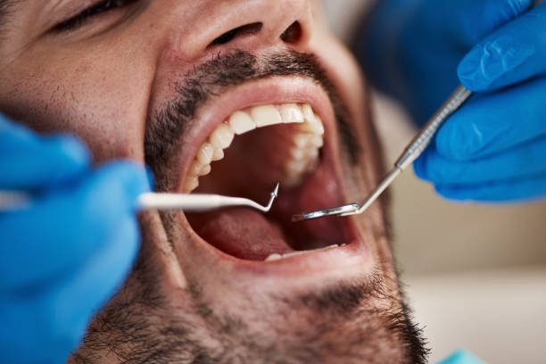 Best Emergency Wisdom Tooth Extraction in Westbury, NY